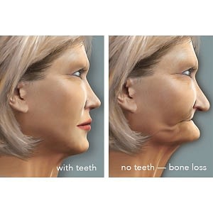 Bone Loss after extraction