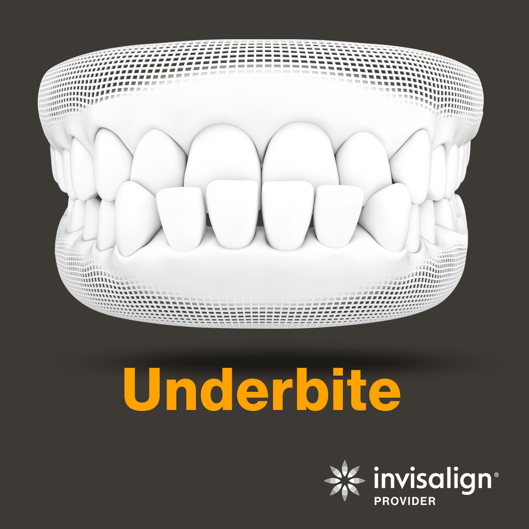 An image from Invisalign displaying a model example of an underbite.