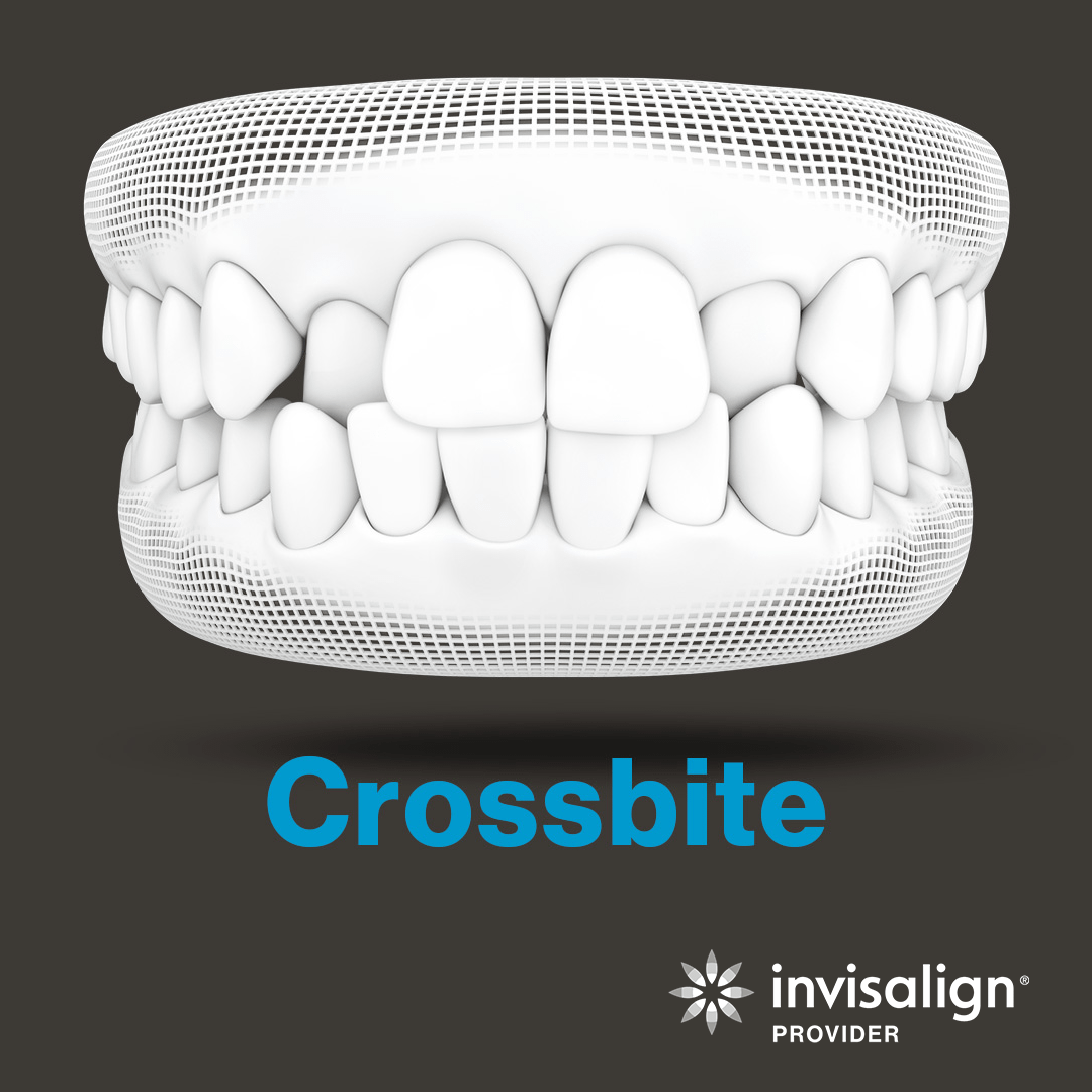 An image from Invisalign displaying a model of a crossbite
