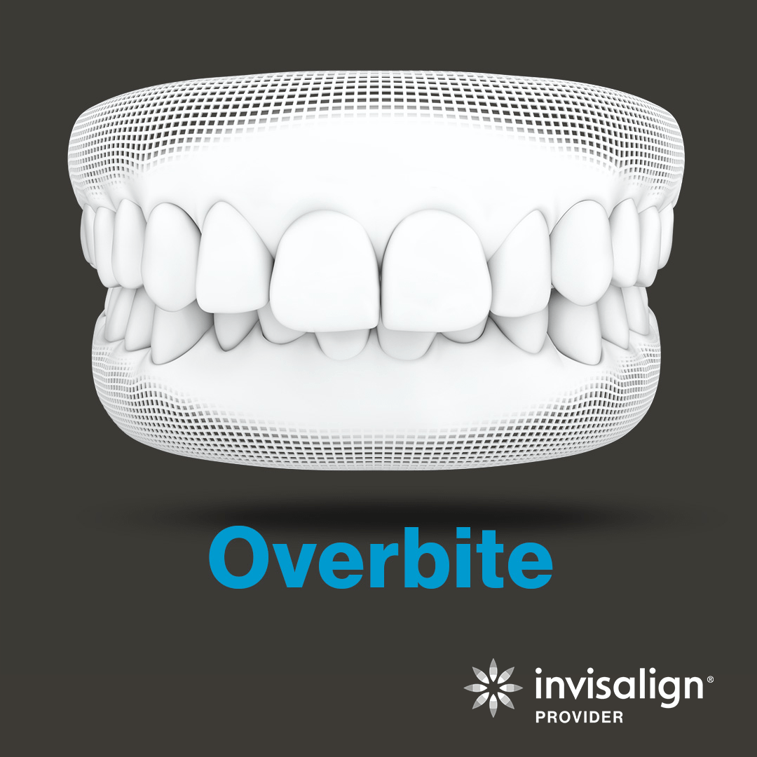 An image from Invisalign displaying a model example of an overbite.