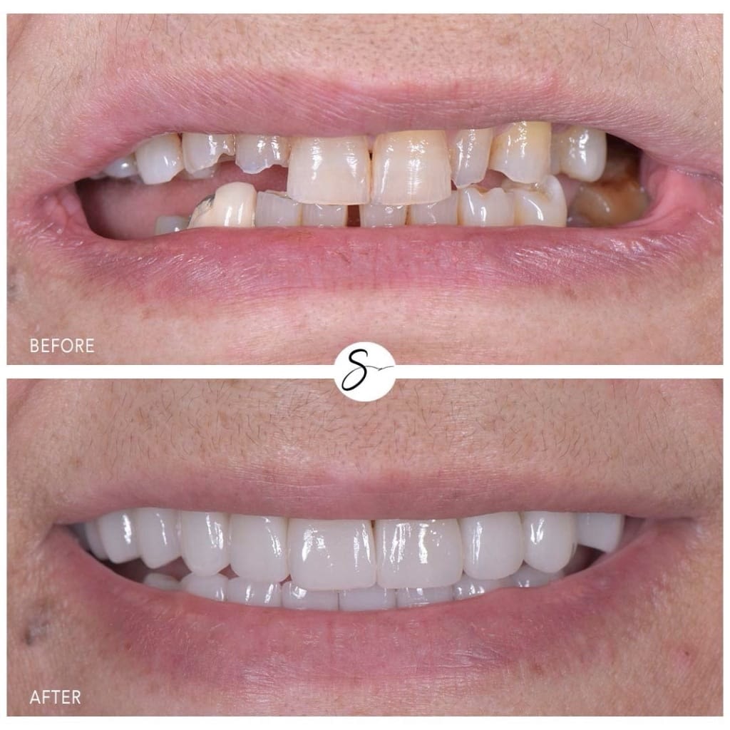 Before and After Smile Transformation