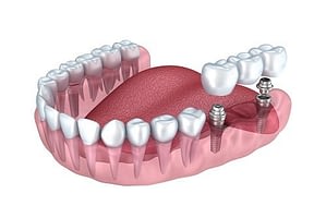 Dental Implant