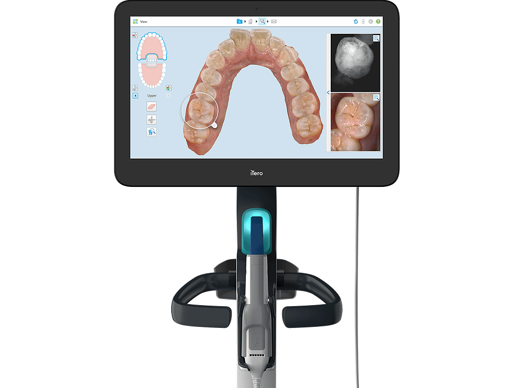 iTero Digital Impressions