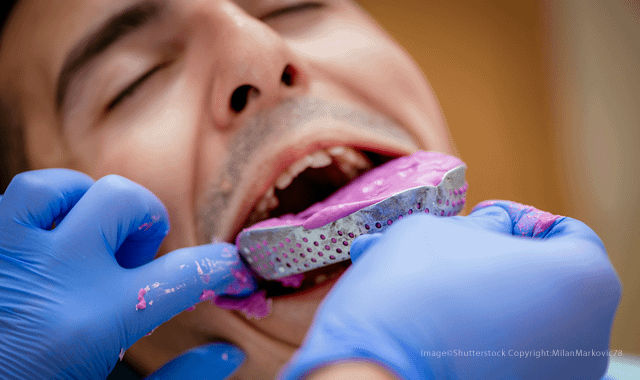 Dental Impressions