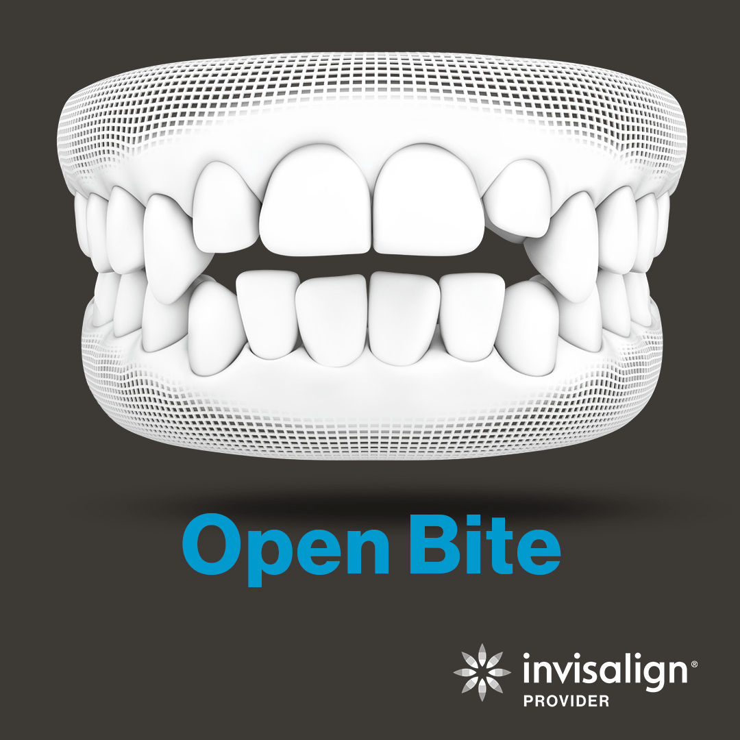An image from Invisalign displaying a model example of an open bite.