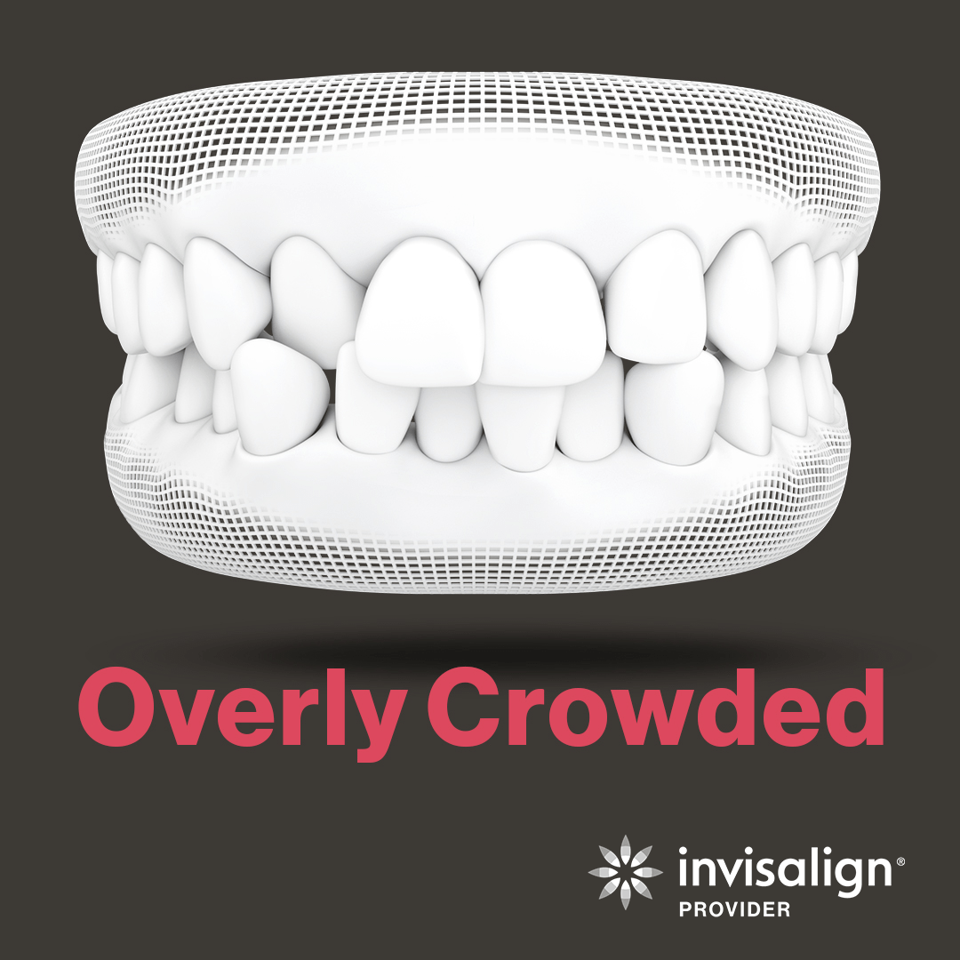 An image from Invisalign displaying a model example of overly crowded teeth.